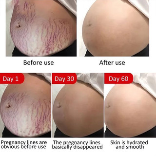 Kem Rạn Da cho bà bầu Loại bỏ sẹo sau khi mang thai Kem Chống Rạn Da 120g Giảm Rạn Hiệu Quả, Phục Hồi Da Nhanh Chóng