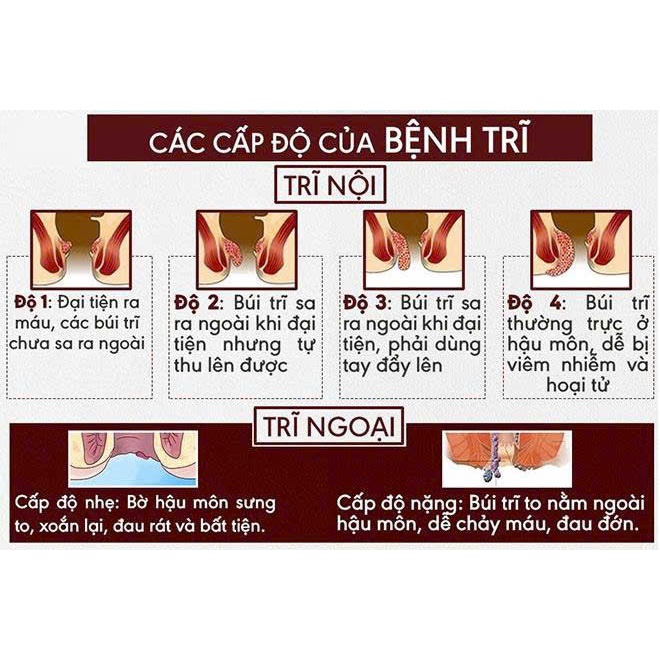 Cao bôi giúp giảm đau rát, trĩ nội trĩ ngoại khi đi vệ sinh của dân tộc Tày
