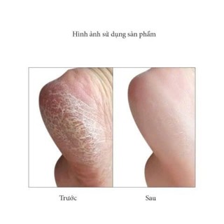 Dụng Cụ Mài Chà Gót Chân Loại 2 – Cây Chà Gót Chân Giúp Da Chân Mịn Màng, Ngăn Nứt Nẻ