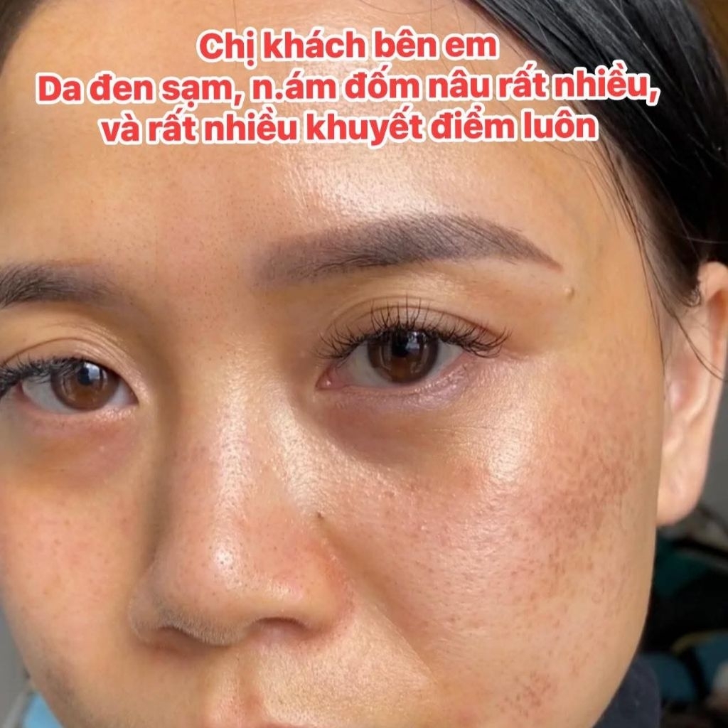 Kem Dưỡng Mờ Thâm BNW+ Dưỡng Sáng Da Cung Cấp Độ Ẩm Hỗ Trợ Làm Dịu Và Làm Mịn Da Bộ 2 Món