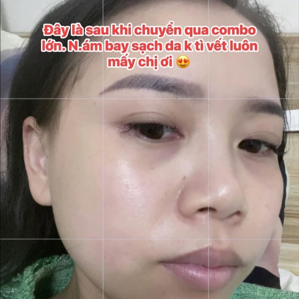 Kem Dưỡng Mờ Thâm BNW+ Dưỡng Sáng Da Cung Cấp Độ Ẩm Hỗ Trợ Làm Dịu Và Làm Mịn Da Bộ 2 Món