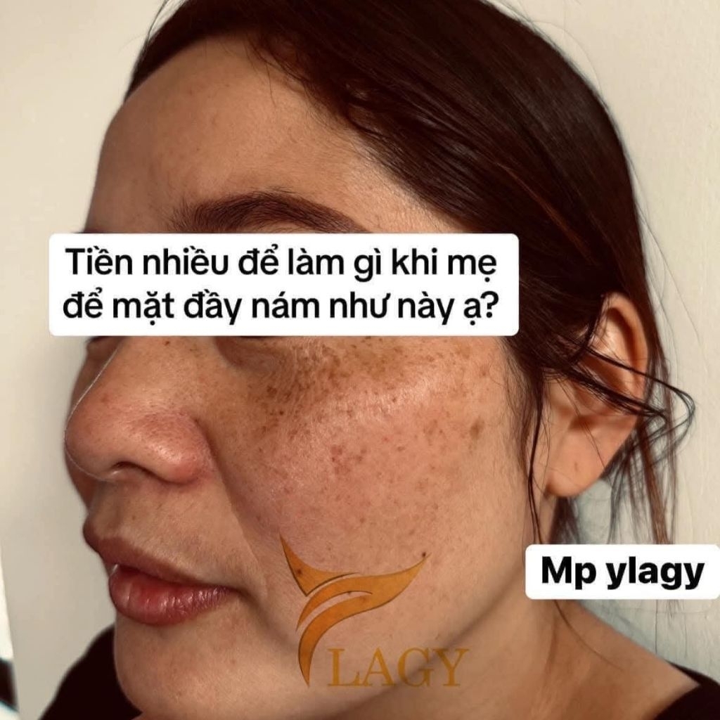 Kem Nám Mờ Thâm Dưỡng Trắng Ylagy Cấp Ẩm Sâu, Phục Hồi Da, Giảm Nám Tàn Nhang, Chống Lão Hóa