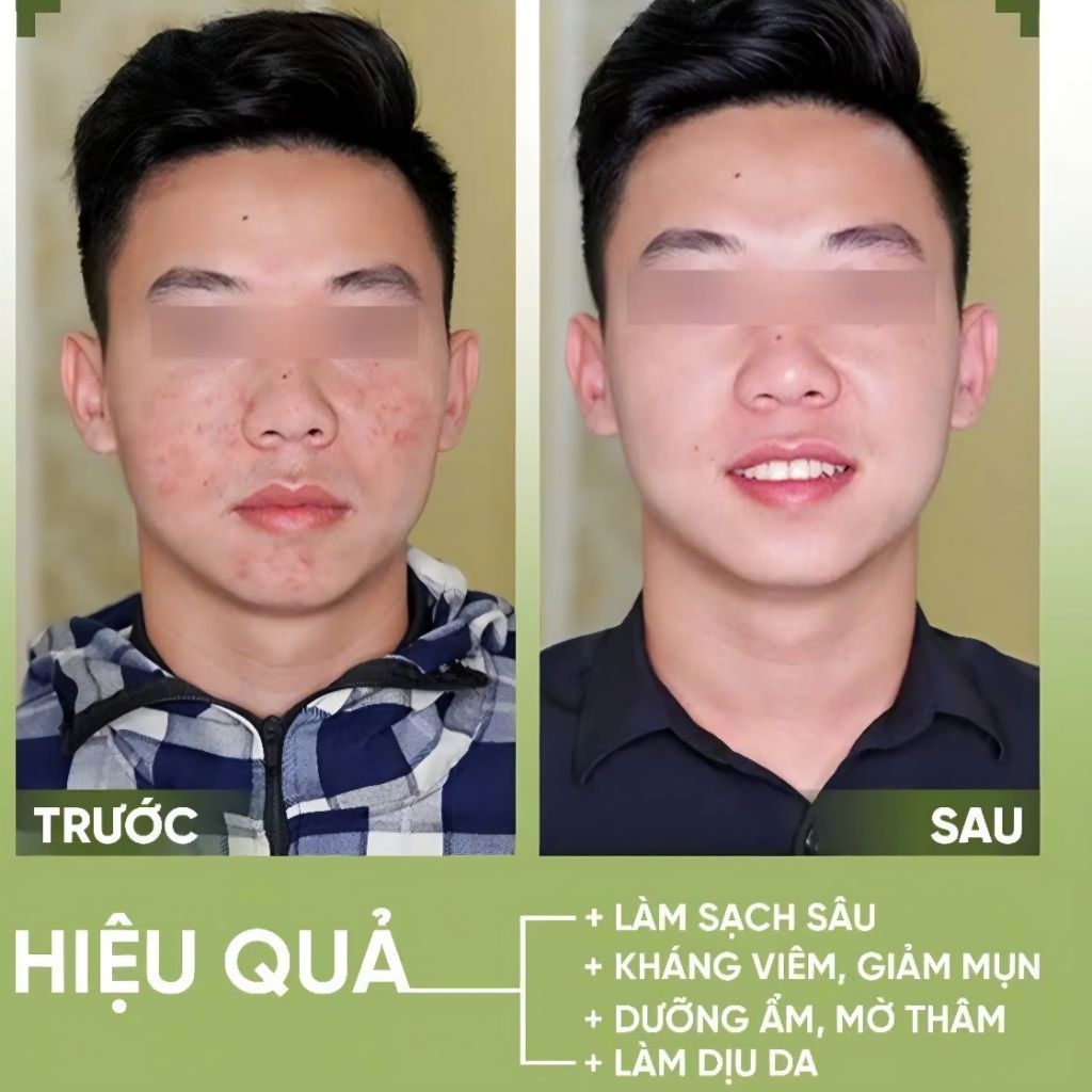 Sữa Rửa Mặt YLAGY Ngừa Mụn Giảm Thâm, Làm Sáng Da, Se Khít Lỗ Chân Lông Tuýp 120ml