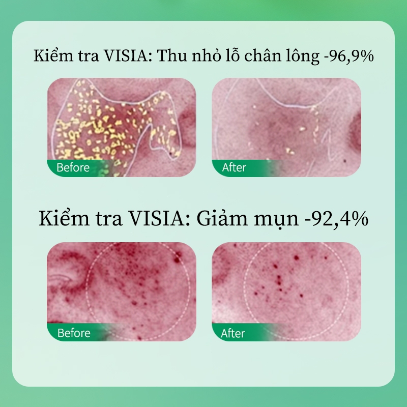 Tinh chất axit Salicylic làm giảm mụn trứng cá vết mụn thu nhỏ lỗ chân lông và làm săn chắc da 30ml