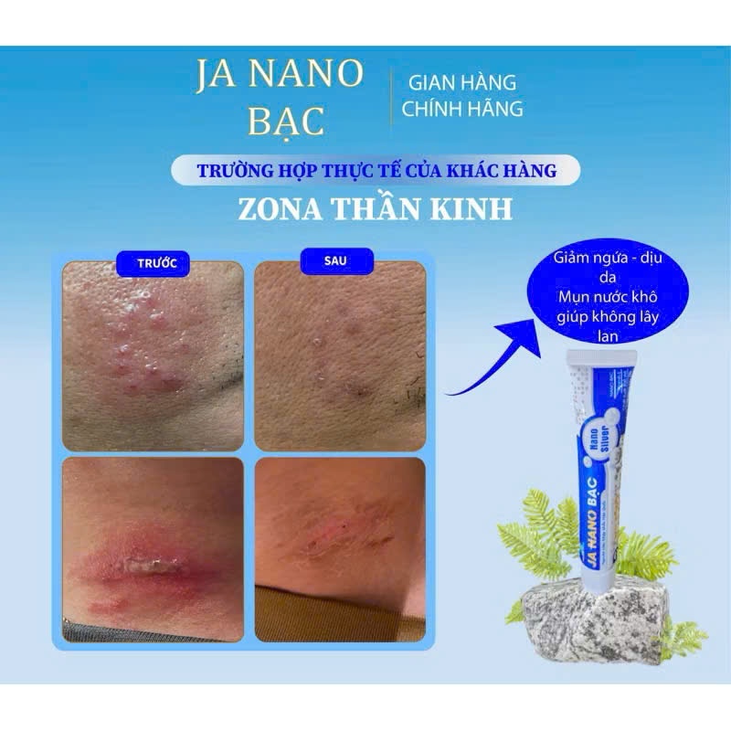 Kem Bôi Nấm Ngứa Viêm Da JA NANO BẠC - Hỗ Trợ Vảy Nến, Viêm Da Cơ Địa, Chàm Da, Da Tiết Bã, Nấm Da, Hắc Lào, Á Sừng