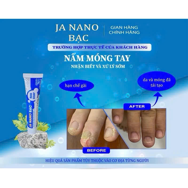Kem Bôi Nấm Ngứa Viêm Da JA NANO BẠC - Hỗ Trợ Vảy Nến, Viêm Da Cơ Địa, Chàm Da, Da Tiết Bã, Nấm Da, Hắc Lào, Á Sừng