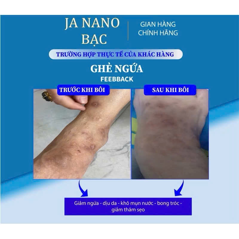 Kem Bôi Nấm Ngứa Viêm Da JA NANO BẠC - Hỗ Trợ Vảy Nến, Viêm Da Cơ Địa, Chàm Da, Da Tiết Bã, Nấm Da, Hắc Lào, Á Sừng