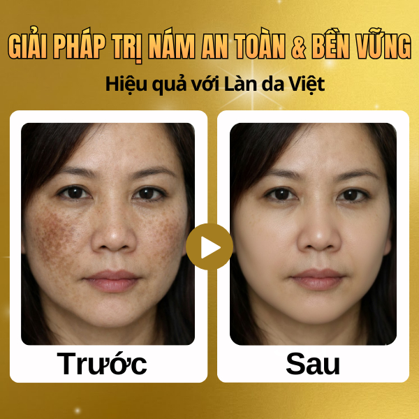 Chất Lượng Kem Renoskin White Melasma Hỗ Trợ Làmờ Vết Nám