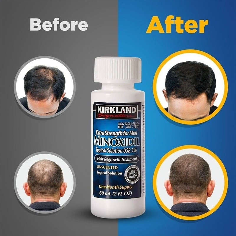 Dung dịch lỏng Seru ROGAINE 5% Minoxidil Obat penumbuh rambut penumbuh rambut cepat serum 60ml
