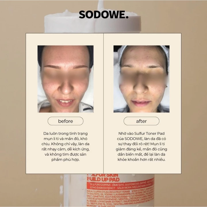 SODOWE SULFUR SKIN GLOW TONER PAD-60 Miếng Toner Pad Lưu Huỳnh Sodowe dành cho da mụn