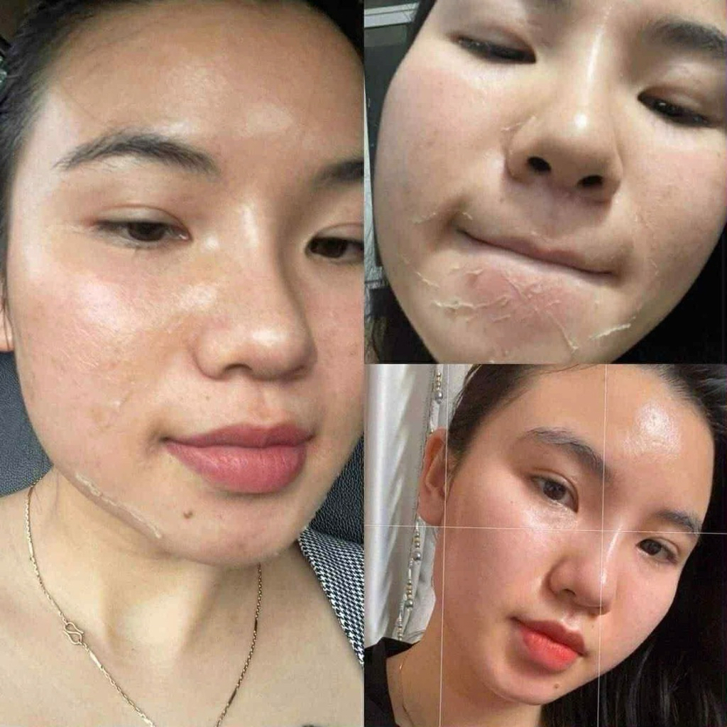 PEEL DA MẶT VI TẢO CAO CẤP - tẩy da chết - giảm mụn mờ nám tàn nhang - peel lột da mặt retinol 10ml