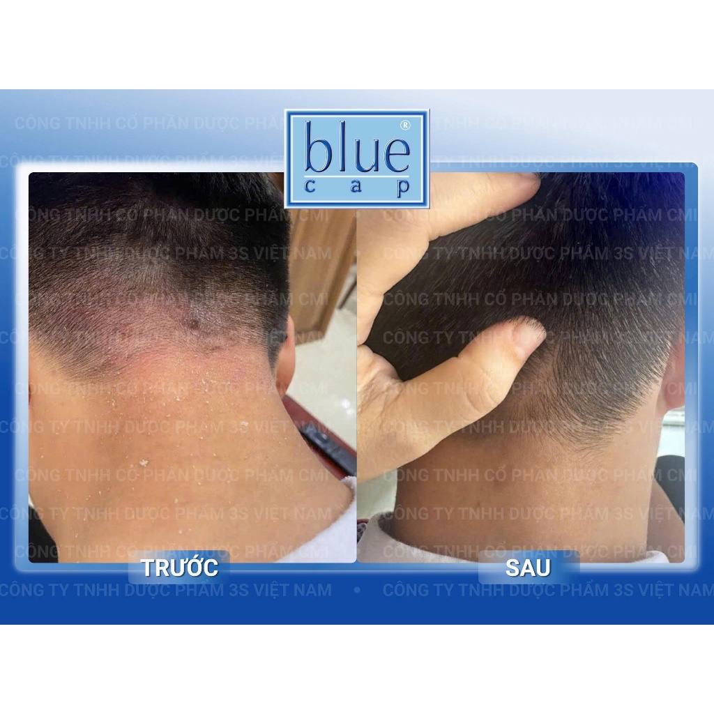 Blue Cap Foam dạng bọt cho vảy nến, viêm da cơ địa, viêm da tiết bã, viêm da dị ứng - Chai 100ml