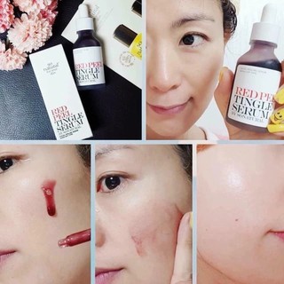 Tinh chất tái tạo da Red Peel Tingle Serum peel da sinh học red peel sáng da - Kosmi Beauty