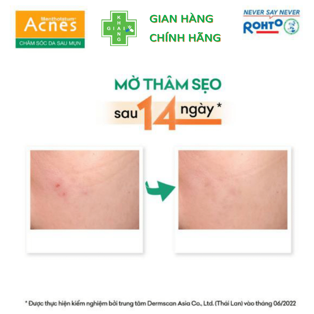 Gel bôi mờ sẹo, giảm thâm mụn Acnes Scare Care (Tube 12g)