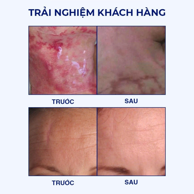 Miếng Dán Mờ Sẹo Scar Fx Ngăn Ngừa Và Sẹp Sẹo Lồi  Phì Đại 2,5cm x 2,5cm