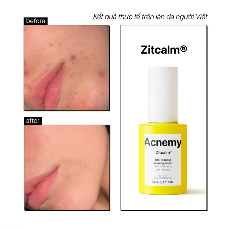Huyết Thanh Giảm Đỏ, Làm Dịu Phục Hồi Da Mụn Acnemy Zitcalm Anti Redness Calming Serum 30ml