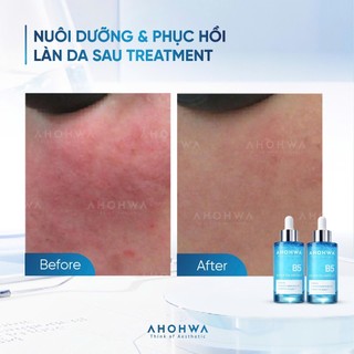 Ahohwa - Tinh chất cấp ẩm và phục hồi da Hydration ampoule B5 _ 30ml
