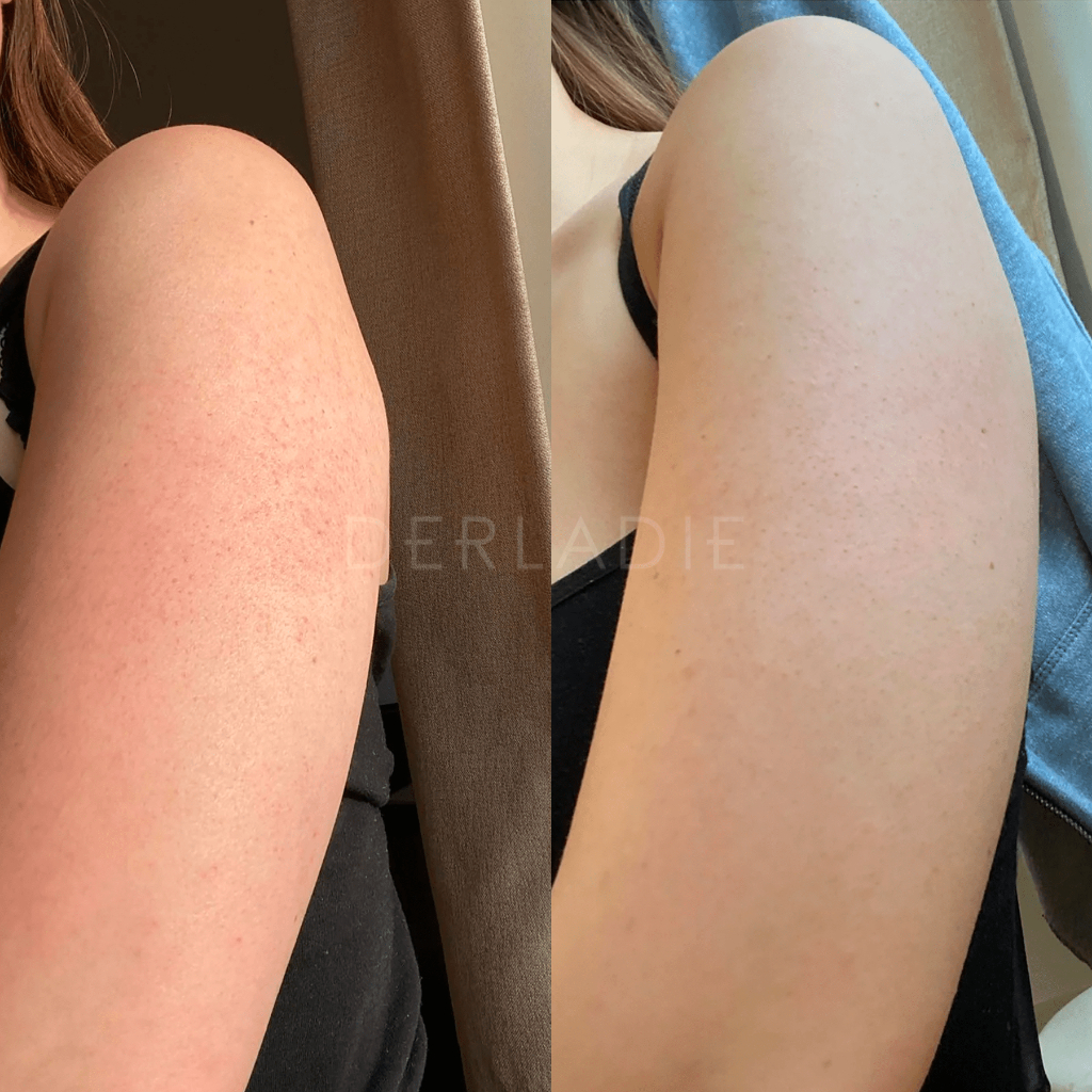 Mô tả (KOL) Xịt Mụn Lưng, Mờ Thâm, Giảm Viêm Nang Lông Derladie Herbal Extract Body Solution Mist 150Ml - 3