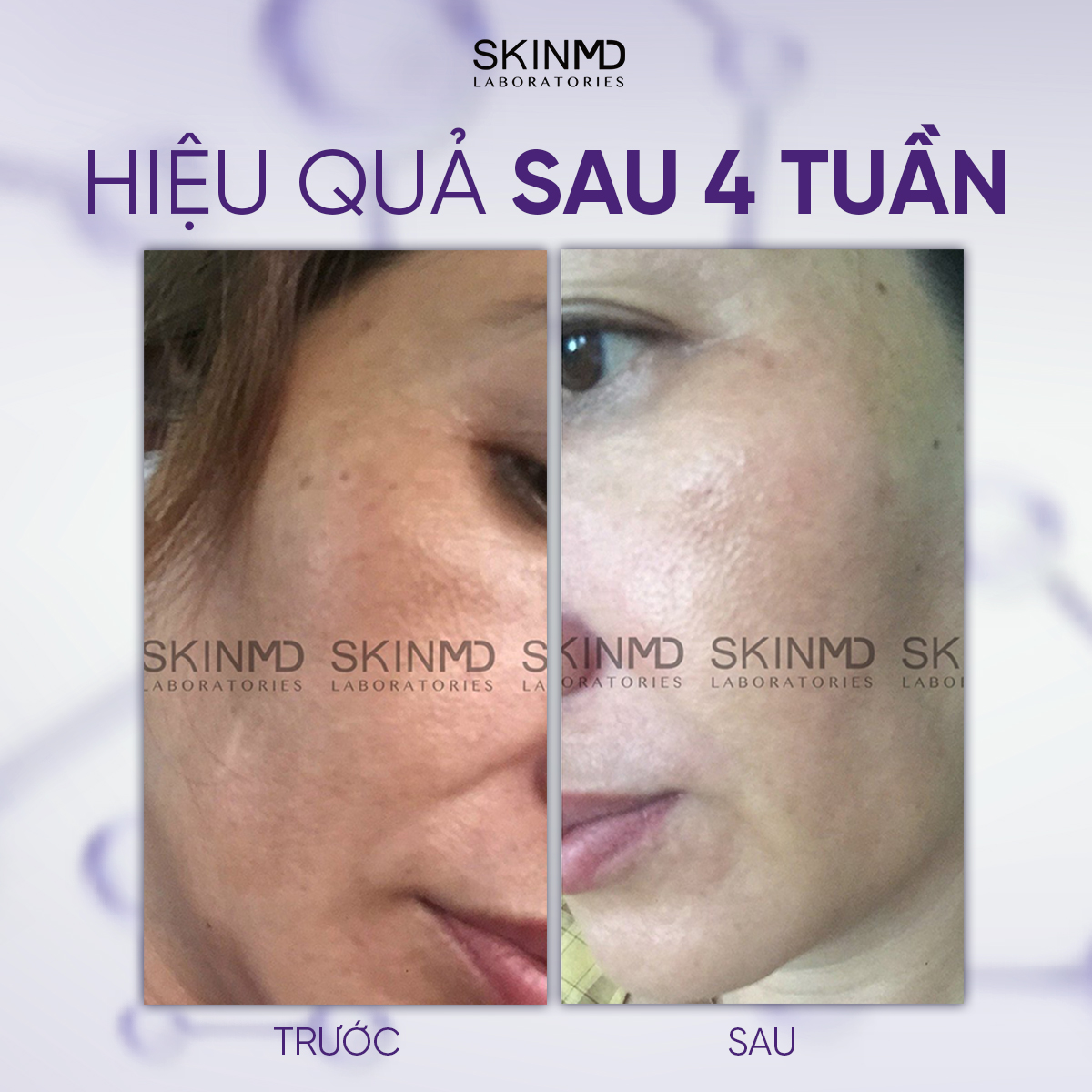 Mô tả Kem giảm sạm nám và phục hồi làn da mỏng yếu nhạy cảm Skinmd Pure Whitenol Cream Intensive 15ml - 3
