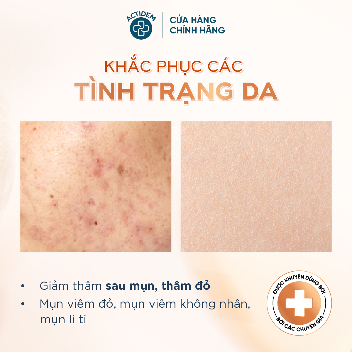 Công dụng chính Actidem Derma Extra Gel