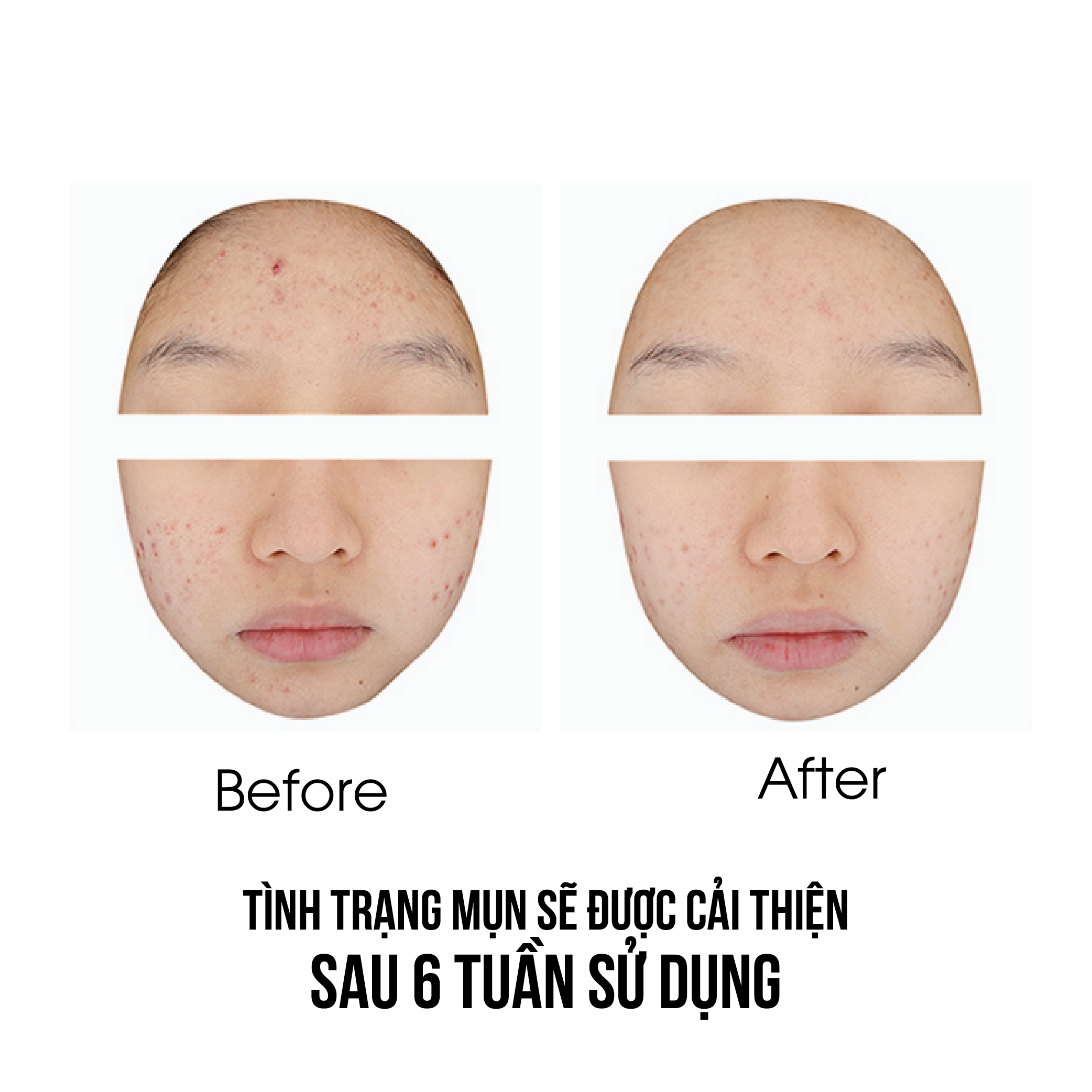 Mô tả Tinh Chất Dưỡng Da Mụn AMPLE:N Acne Shot Ampoule 30ml - 6