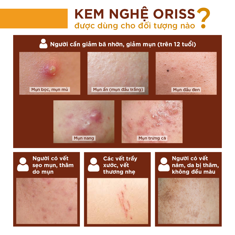 Mô tả Kem nghệ Oriss giảm mụn và thâm không gây vàng da dành cho da dầu mụn tuýp 20gr - 4