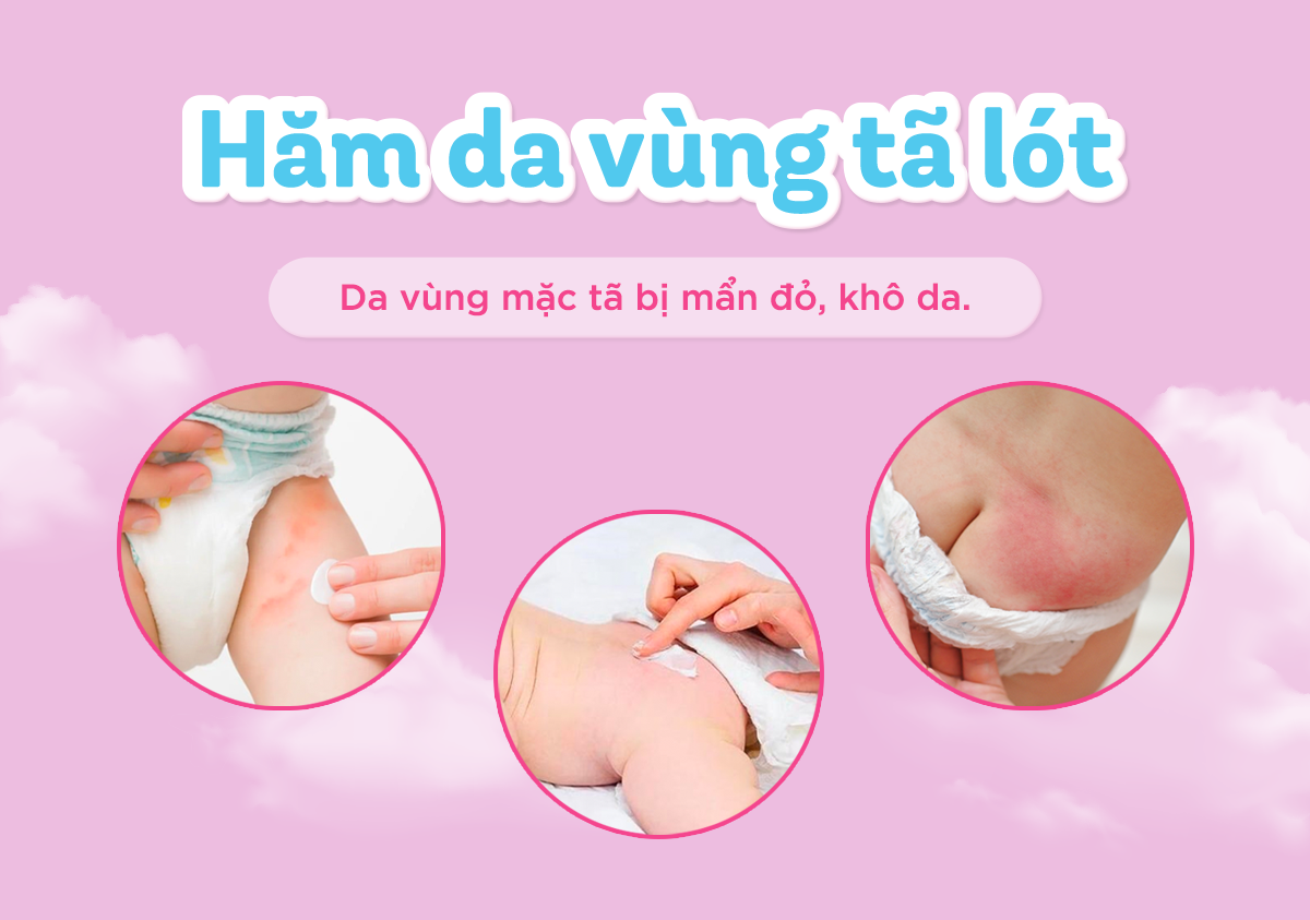 Mô tả Bộ 4 tuýp kem chống hăm Bepanthen Balm dạng kem mỡ 30g/tuýp - 2