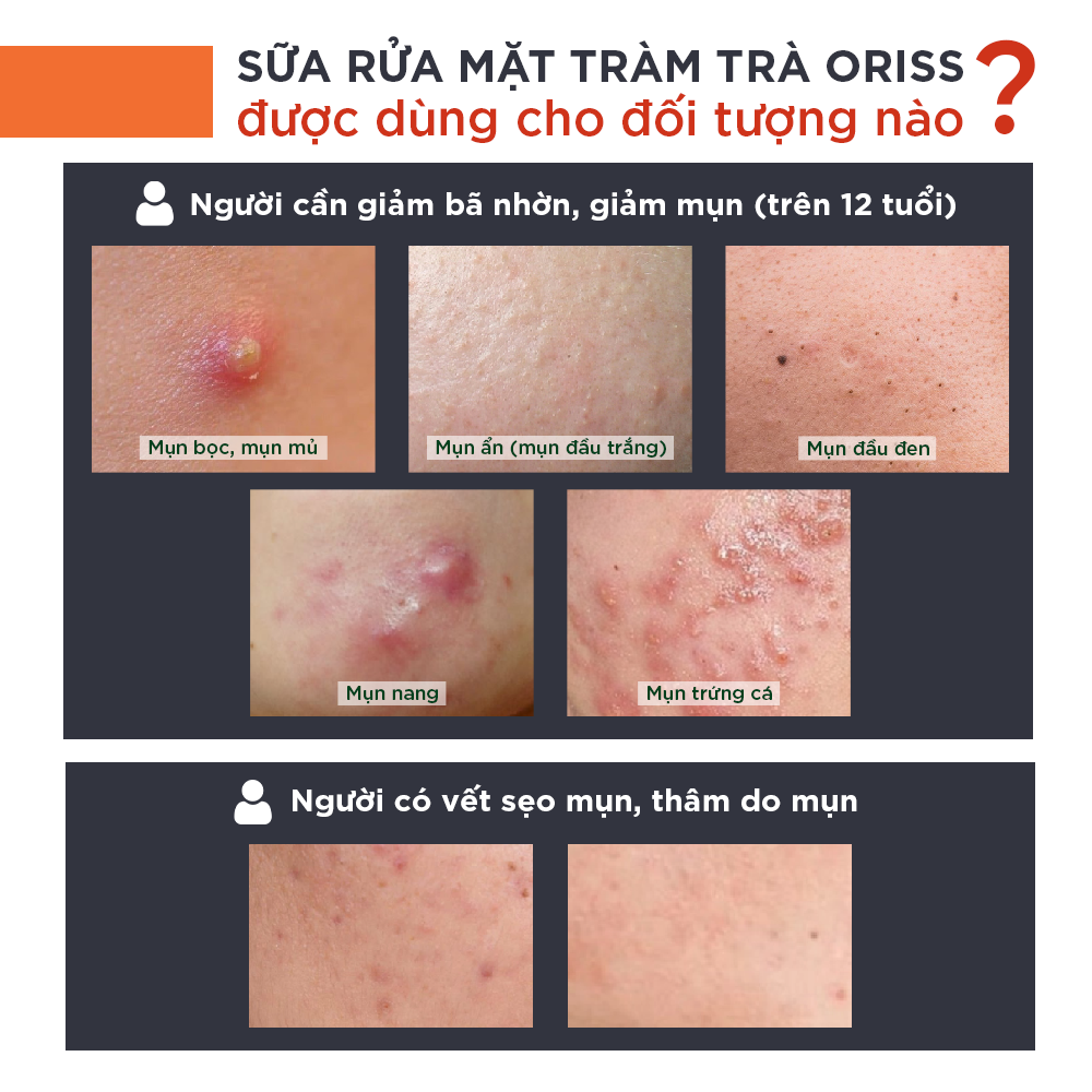 Mô tả Sữa rửa mặt ngừa mụn Oriss dưỡng ẩm tẩy tế bào chết thu nhỏ lỗ chân lông 100g - 4