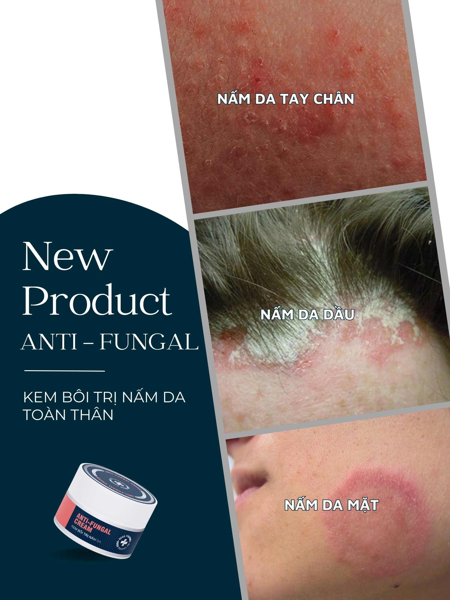 Mô tả Combo dầu gội & kem bôi da dứt điểm nấm da đầu, viêm da, vảy nến Dego Pharma - 9