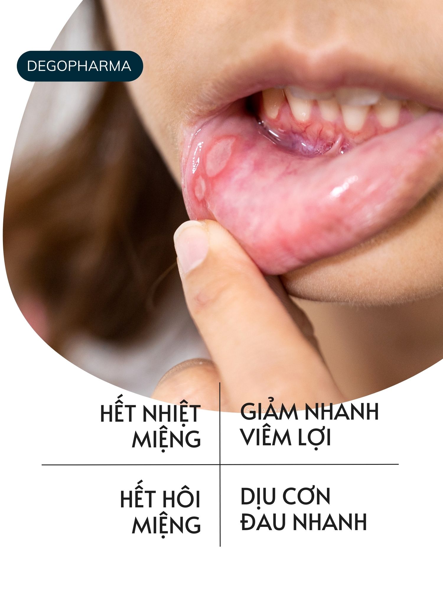 Mô tả Xịt Dứt Điểm Nhiệt Miệng, Nhiệt lưỡi, Lở môi, Viêm Lợi Dego Pharma - Dịu Cơn Đau Loét Miệng, Hết Hôi Miệng - 3