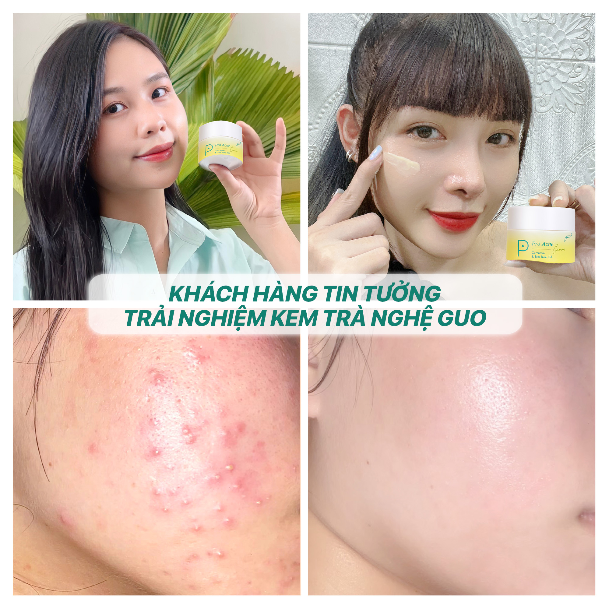 Mô tả Kem nghệ cho bà bầu kiềm dầu giảm mụn mờ thâm GUO 30g [Tràm trà và nghệ] - 2