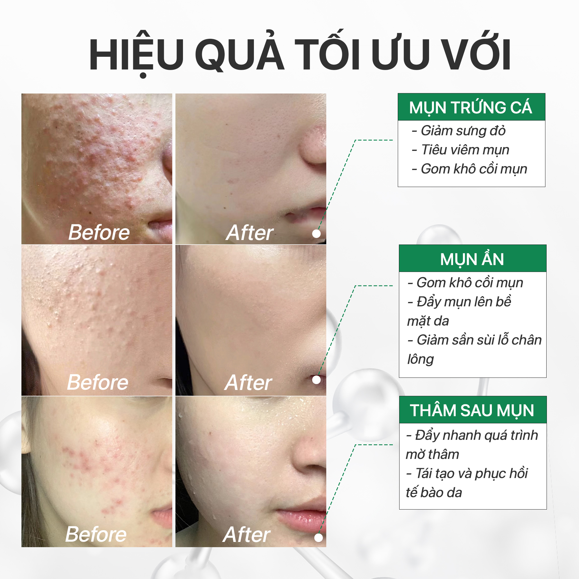 Mô tả Serum sạch mụn giảm thâm chuyên cho bà bầu da mụn, gom khô mụn với tràm trà GUO 10ml, 30ml - 2