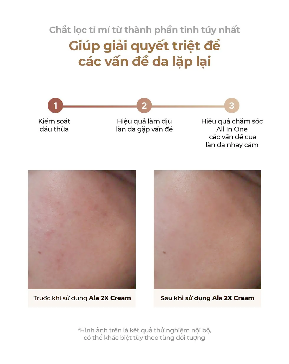 Mô tả Kem Dưỡng Da Be'Balance ALA 2X CREAM giúp Chăm Sóc Da có Vấn Đề về Mụn 50gr - 5
