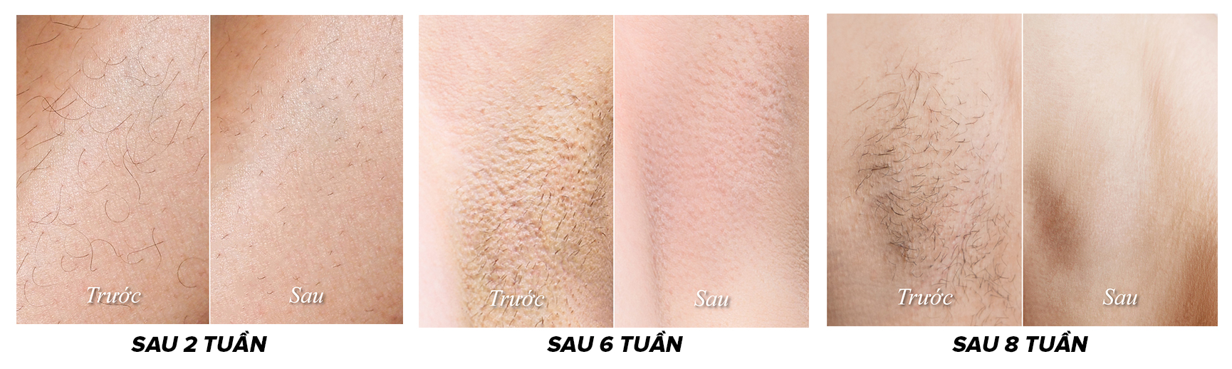 Mô tả Máy Triệt Lông Băng Lạnh TRẺ HÓA DA IPL Maxcare M2 Bản Cao Cấp Tích Hợp Cảm Biến Da, Năng Lượng 19J Tăng 35% Hiệu Quả - 1