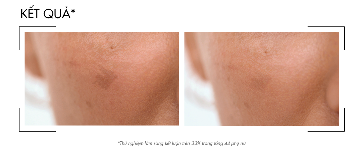 Mô tả Tinh chất giúp cải thiện & ngăn ngừa thâm nám đốm nâu Vichy Liftactiv B3 dark spots 30ml - 6
