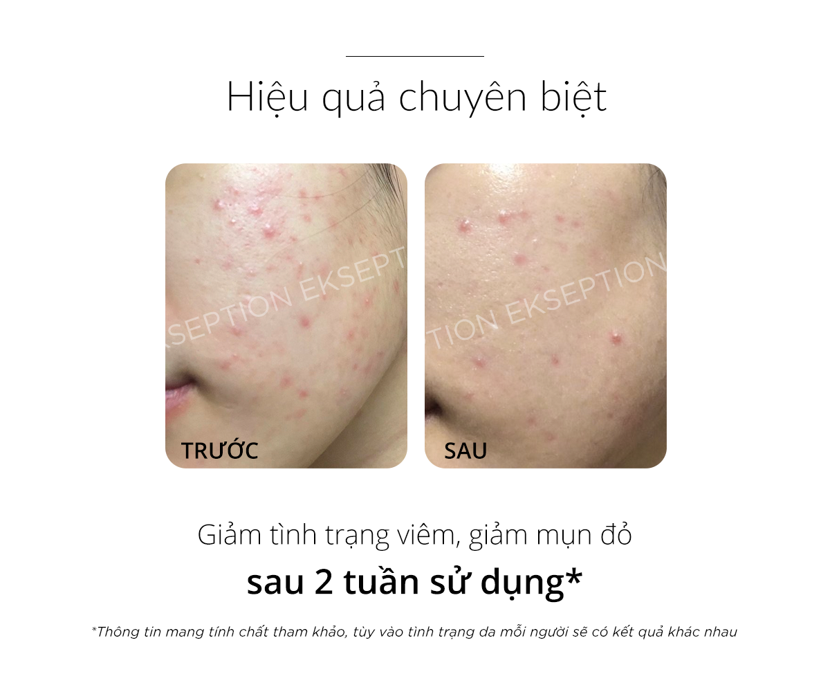 Mô tả Serum kẽm Ekseption Hyaluronic ZnPCA, HA + 1% ZnPCA giảm mụn, kiềm dầu 75ml - 3