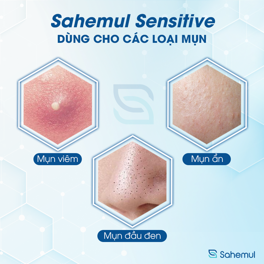 Gel Giảm Mụn Sensitive Sahemul