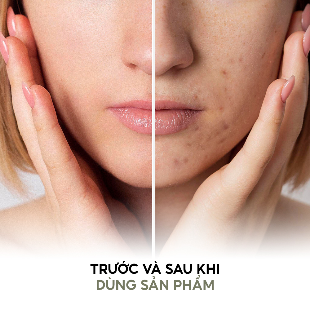 Mô tả Sữa rửa mặt dành cho da dầu và da hỗn hợp, da khô và da nhạy cảm Tenamyd Cosmetic120gr - 7