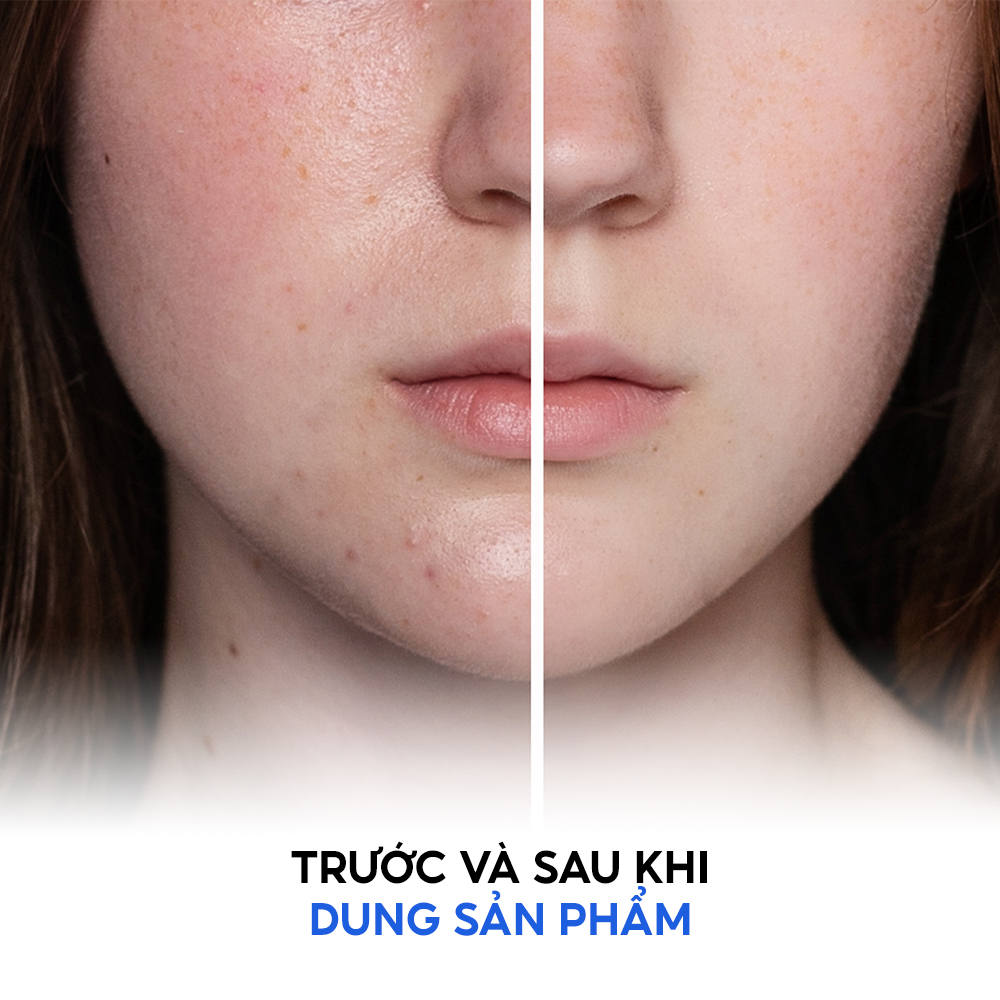 Mô tả Sữa rửa mặt dành cho da dầu mụn Tenamyd Cosmetic 120gam - 4