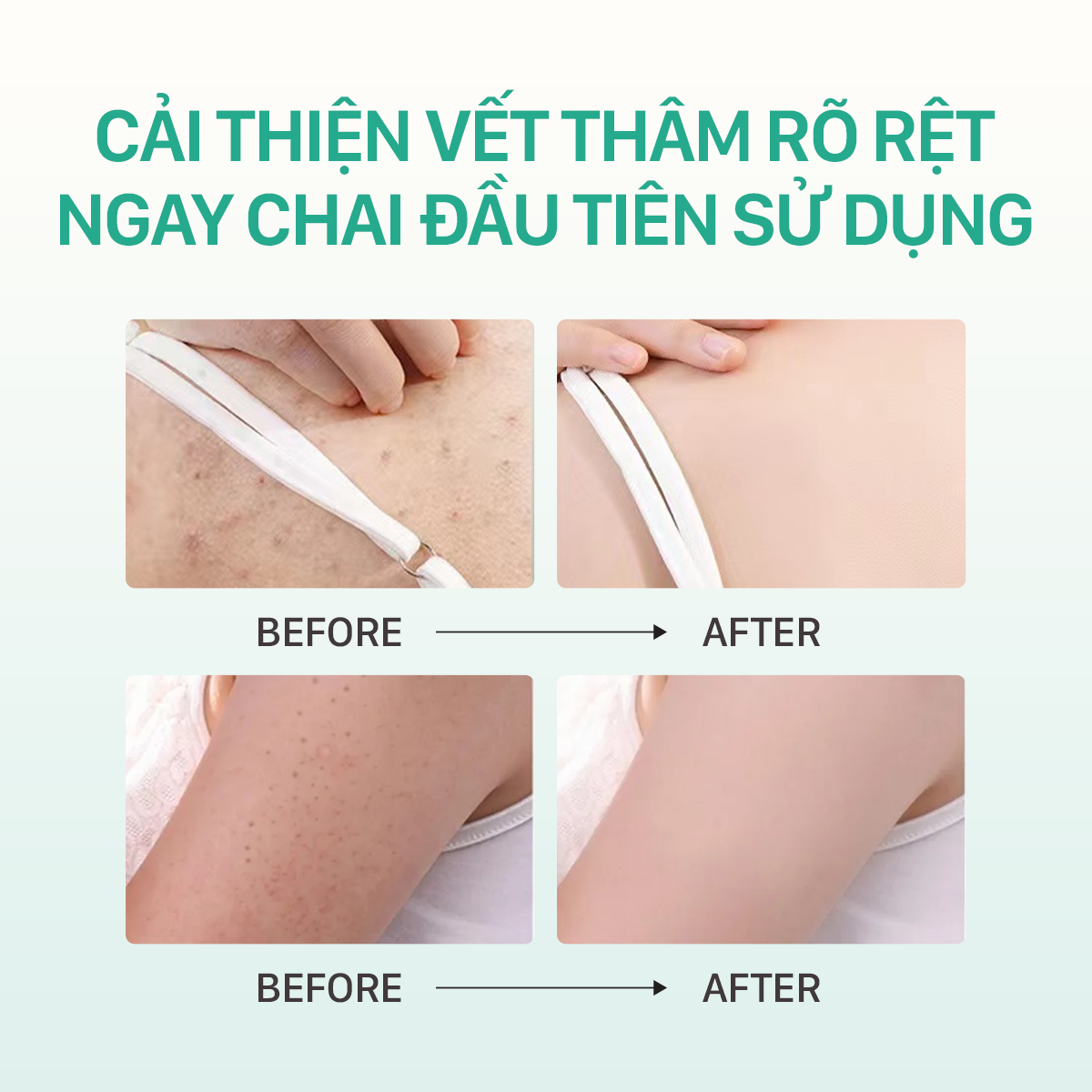 Mô tả Xịt mụn mờ thâm UMIHA (45ml) - x2 hiệu quả ngừa viêm nang lông, ngừa mụn, trắng da với BHA và Nano Bạc - 4