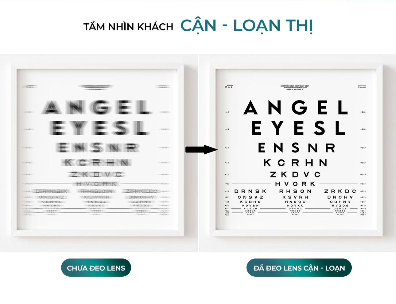 Mô tả Lens cận loạn thị Angel Eyes - Độ cận 0 - 8.00 độ - Độ loạn từ 0.75 đến 2.75 độ - 5 trục cơ bản 0, 20, 90, 160, 180 - 2