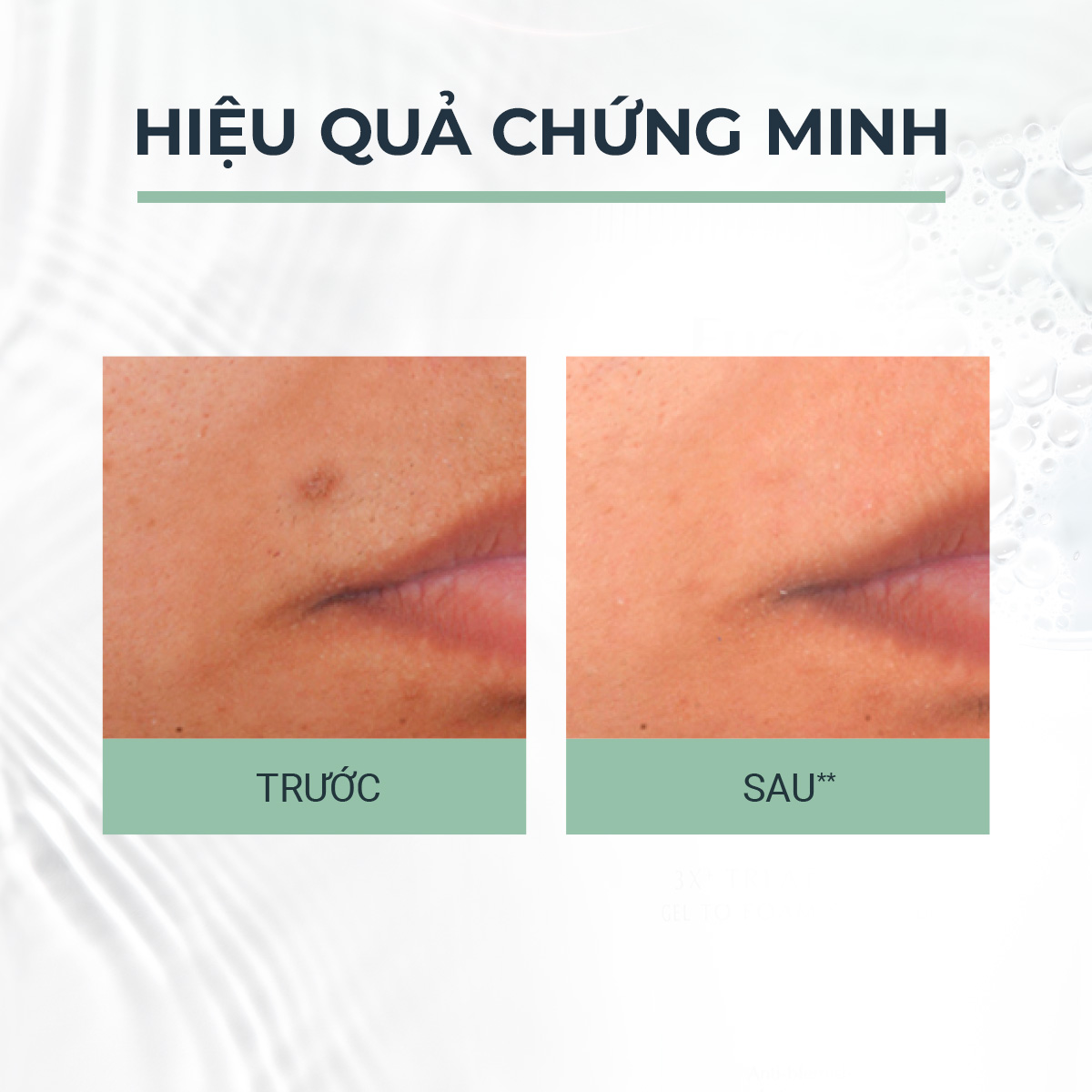 Mô tả Tinh chất giảm thâm & dưỡng sáng cho da mụn Eucerin Pro Acne Triple Effect Serum 40ml - 2