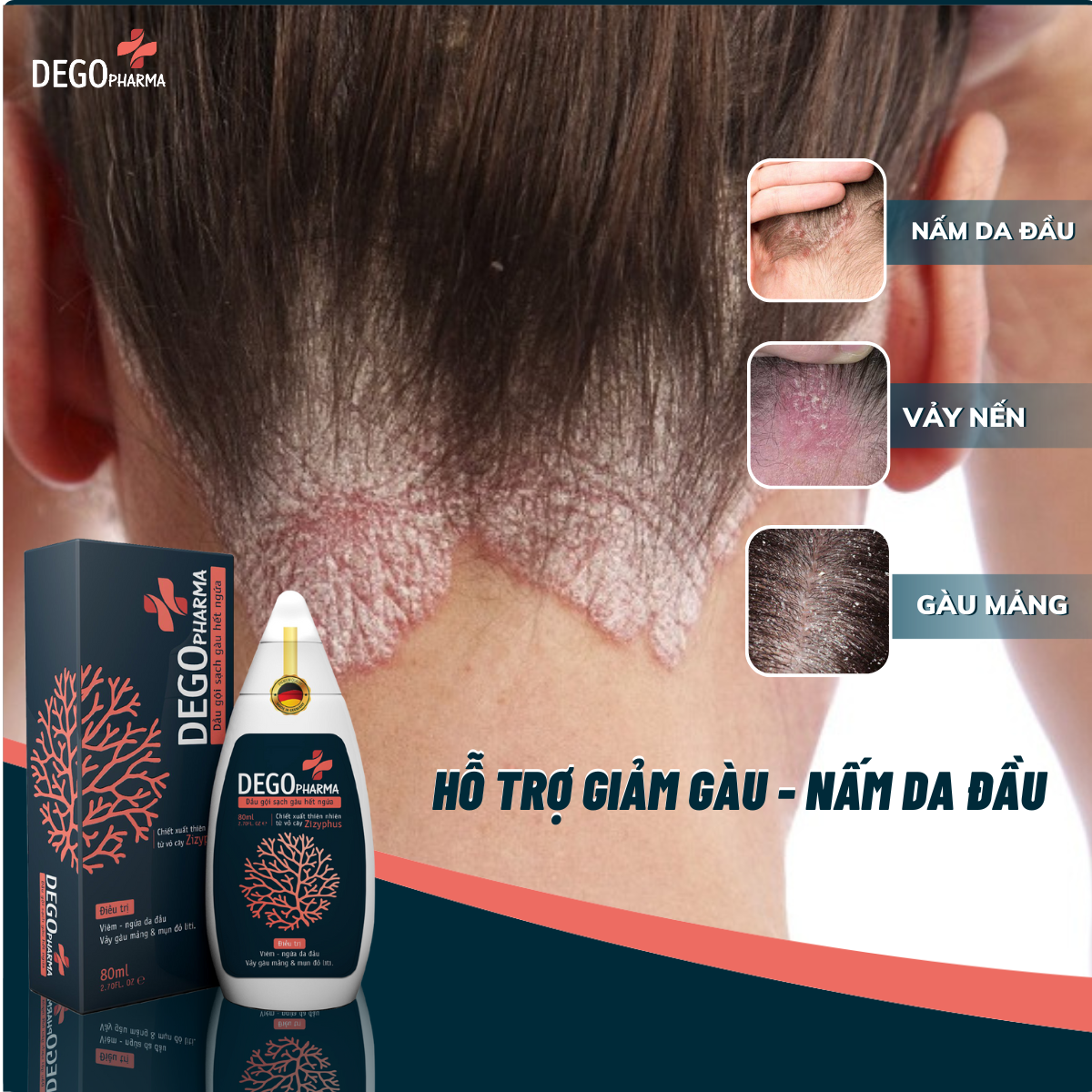 Mô tả Dầu Gội Sạch Gàu Nấm DEGO PHARMA 80ml Dứt Điểm Gàu Ngứa & Nấm Da Đầu Sau 1 Tuần - 2