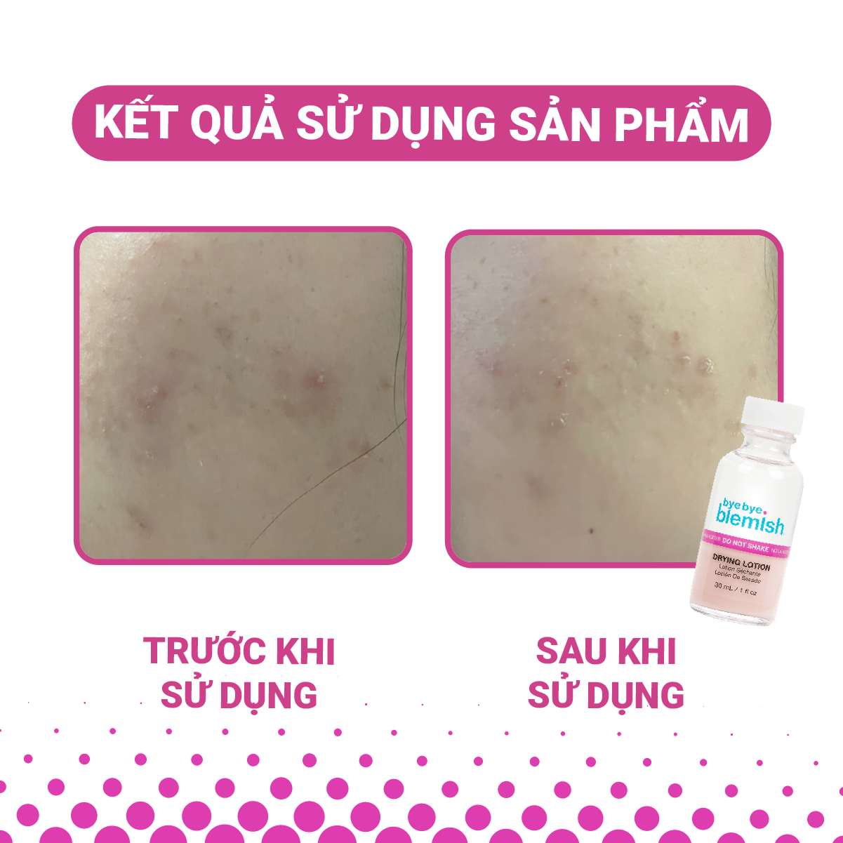 Mô tả Combo Chấm mụn Original dành cho mụn đầu trắng, sưng đỏ và Chấm mụn Vitamin C dành cho da mụn thâm - 6