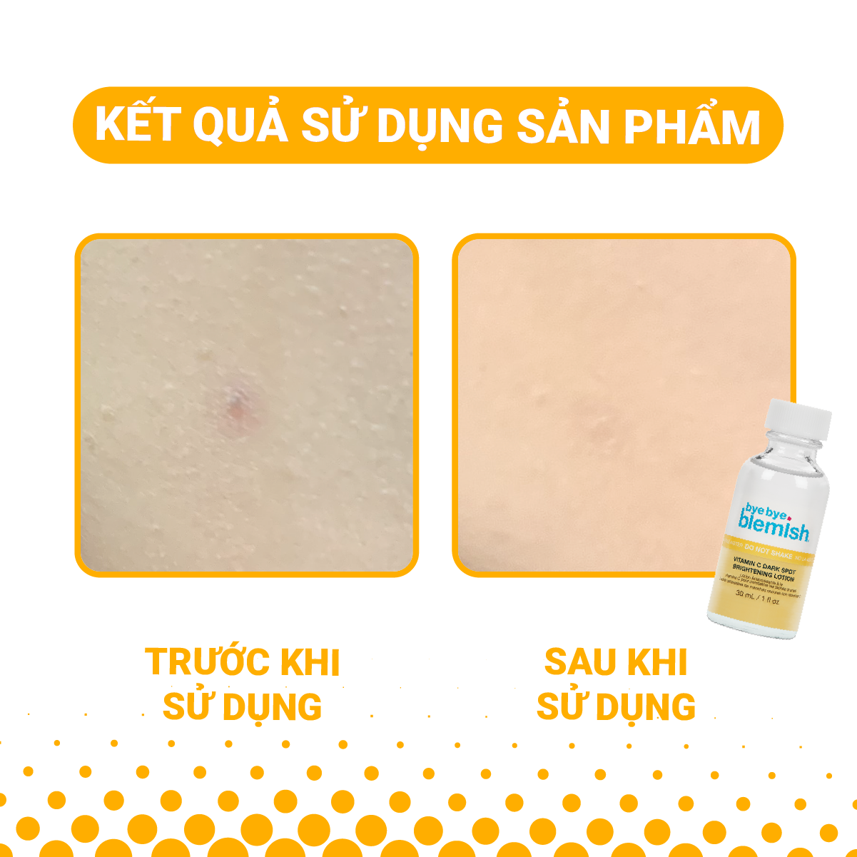 Mô tả Combo Chấm mụn tro núi lửa dành cho mụn trắng, sưng đỏ và Chấm mụn Vitamin C dành cho da mụn thâm 30ml - 3