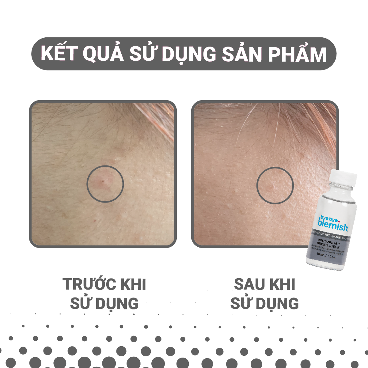 Mô tả Combo Chấm mụn tro núi lửa dành cho mụn trắng, sưng đỏ và Chấm mụn Vitamin C dành cho da mụn thâm 30ml - 6
