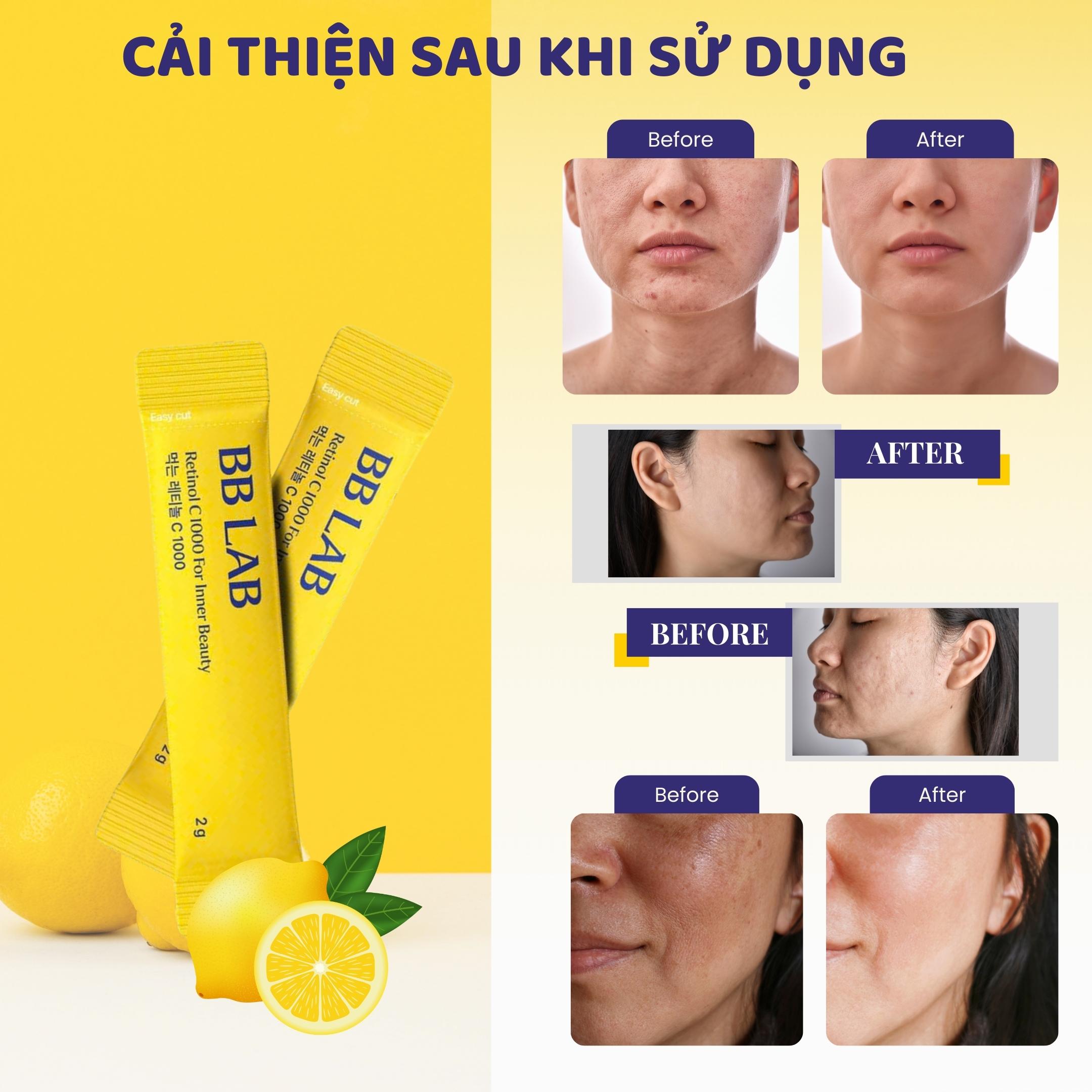 Mô tả Bột BB LAB Retinol C 1000 - Trẻ Hóa Da, Tăng Collagen, Mờ Thâm, Giảm Mụn, Se Khít Lỗ Chân Lông (30 Gói/Hộp) - 2