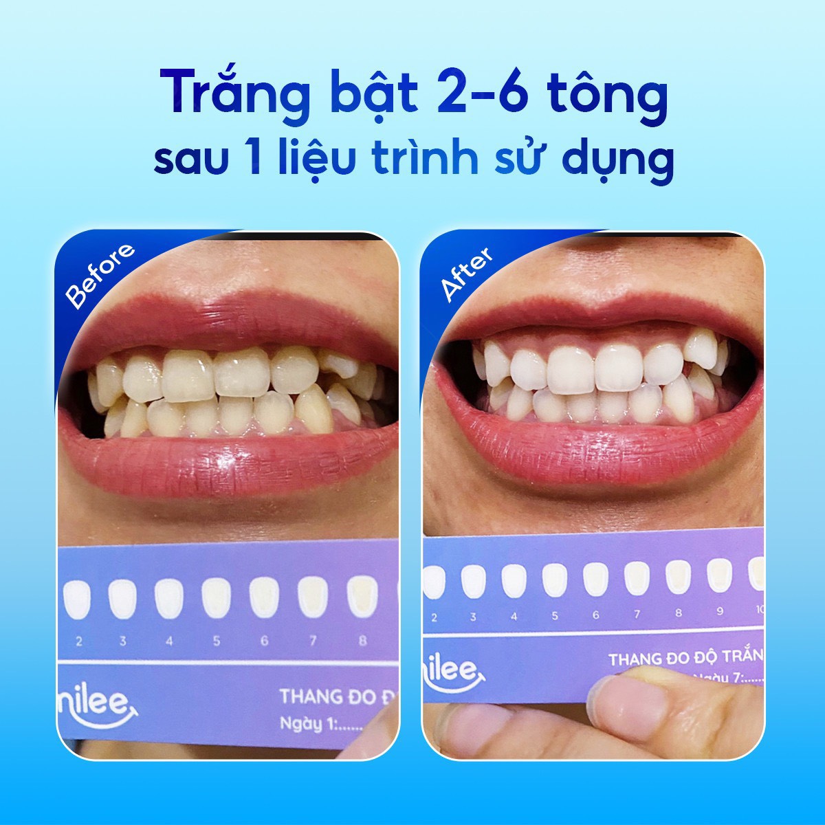 Công dụng Kit Smilee Extra
