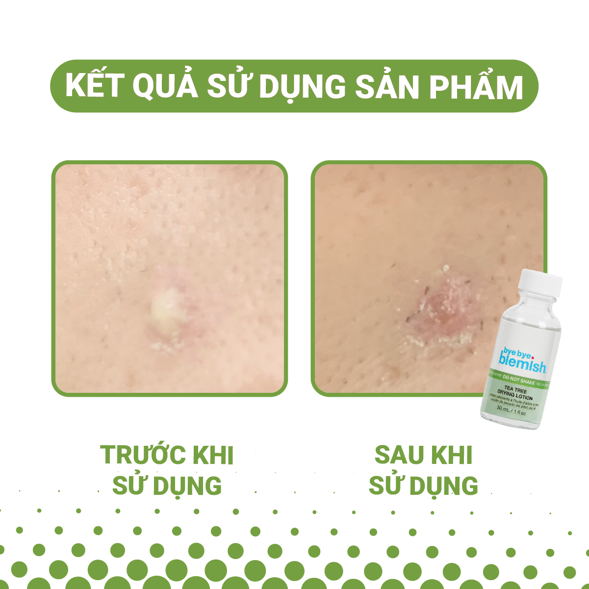 Mô tả 2 Chấm Mụn/Thâm Mụn Bye Bye Blemish cho tất cả các loại mụn trên mặt 30ml x 2 - 4