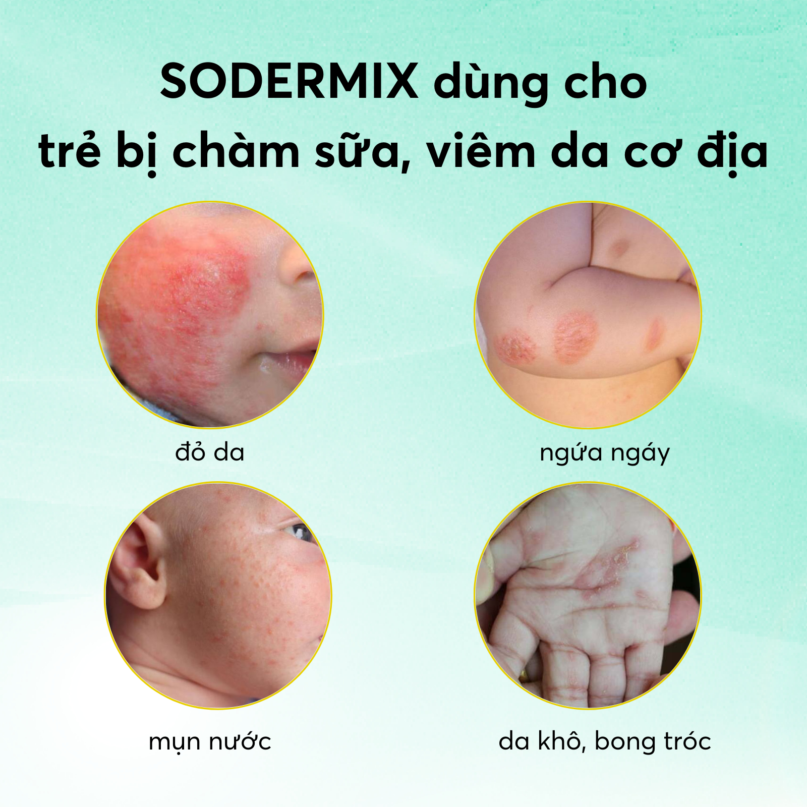 Mô tả Kem Bôi Chàm Sữa SODERMIX 30g - Tặng Mây Hồng Cho Mẹ - Hỗ Trợ Giảm Ngứa Ngáy, Viêm Da Cơ Địa, Mẩn Đỏ, Dưỡng Ẩm Cho Bé - 1